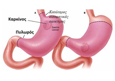 karkinos stomaxou 2
