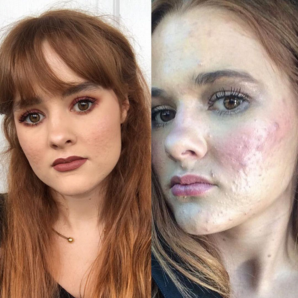 Kali_Kushner_acne_12.jpg