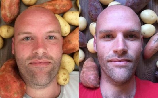 Έτρωγε για έναν ολόκληρο χρόνο μόνο πατάτες και έχασε 52 κιλά!