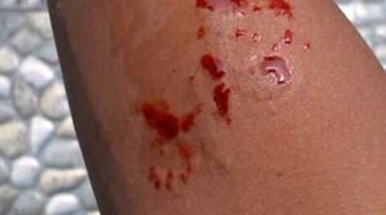 Ινδονησία: 14χρονος πέθανε από κόμπρα ενώ δημοσίευσε στα social media φωτογραφίες