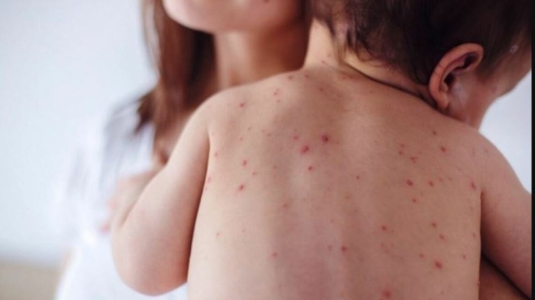 ΠΟΥ: 10,3 εκατ. άνθρωποι προσβλήθηκαν από ιλαρά το 2023 – Άλμα 20%